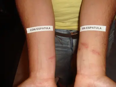 Comparación de dos brazos: uno con la aplicación de la espátula Meduclean y otro sin ella, mostrando menos inflamación, menos irritación y mayor efectividad en el primero.